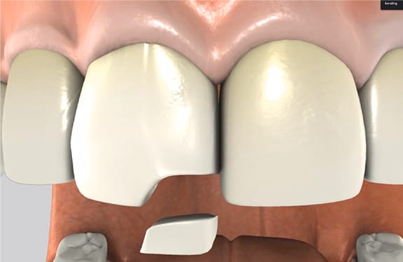Dental Bonding Procedure