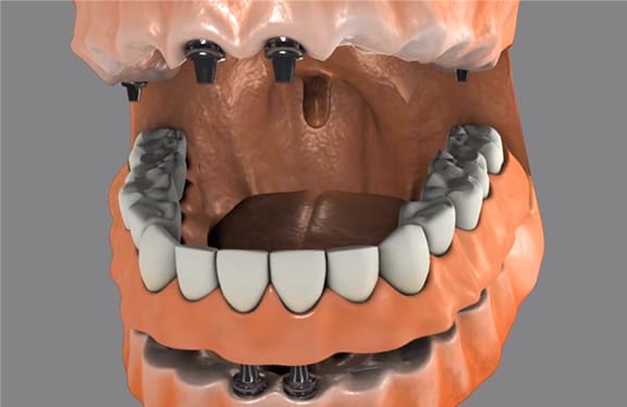 Implant Supported Dentures