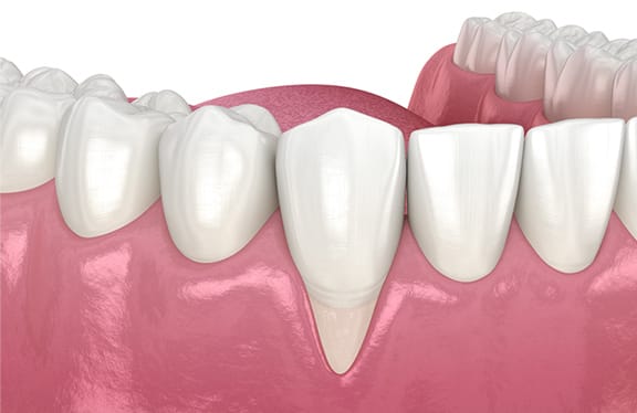 Before & After of Soft Tissue Grafting