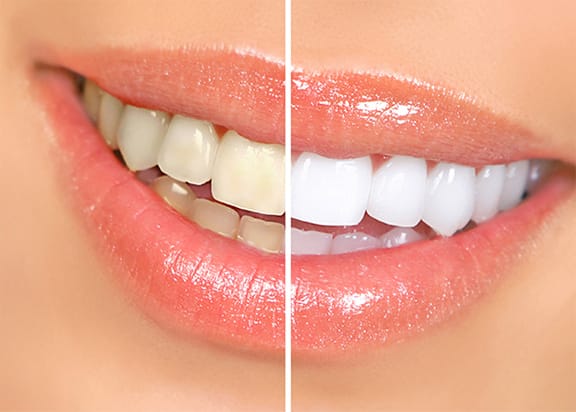 ZOOM Whitening